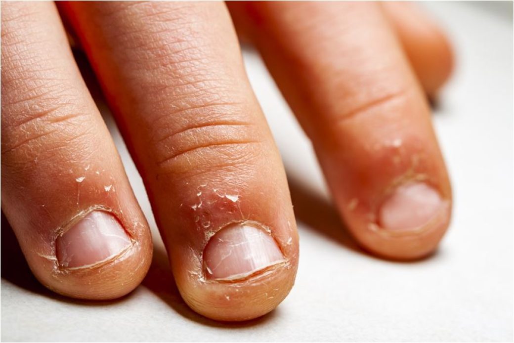 American Academy of Dermatology - Nail biting is a problem for both  children and adults alike. Repeated nail biting can cause tissue damage and  leave you vulnerable to infection. Quit for good